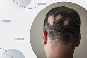 Вырывание волос на голове - как лечить трихотилломанию?