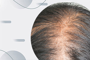 Заболевания щитовидной железы вызывают выпадение волос: как исправить?