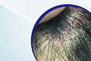 Применение Спиронолактона от выпадения волос