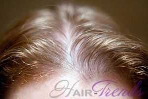 Фолликулит вызывает выпадение волос: причины и эффективное лечение