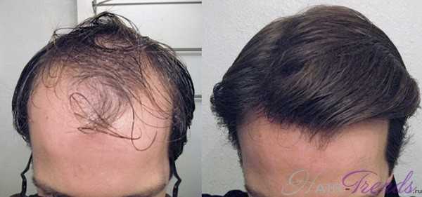 Как происходит пересадка волос и помогает ли она