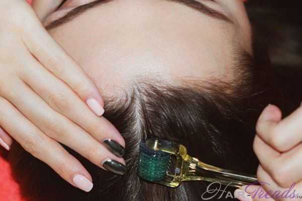Как выбрать размер игл мезороллера для лечения выпадения волос