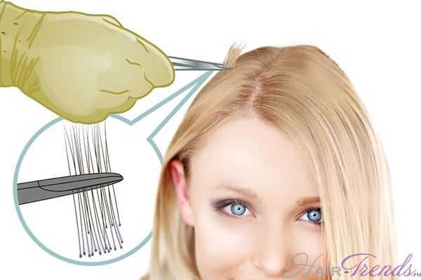 Как выщипывание волос может остановить облысение