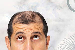 Выпадение волос из-за гормонального дисбаланса и как его лечить
