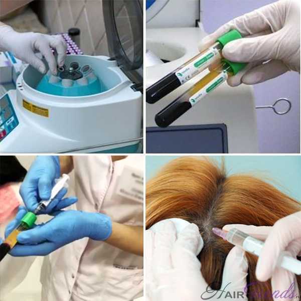 Как происходит процедура плазмолифтинга волос