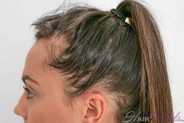 Послеродовое выпадение волос