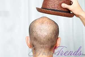 Шампунь Regenepure с кетоконазолом против выпадения волос/