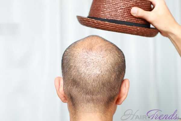 Возможно ли выпадение волос из-за шапки?