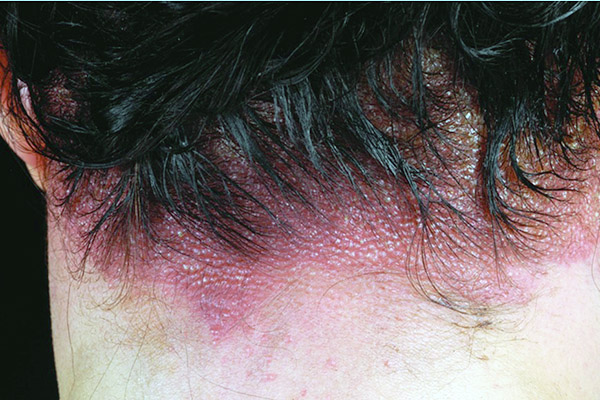Симптомы аллергического дерматита на краску для волос