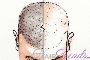 Как гормон ДГТ вызывает выпадение волос? Как уменьшить его воздействие/