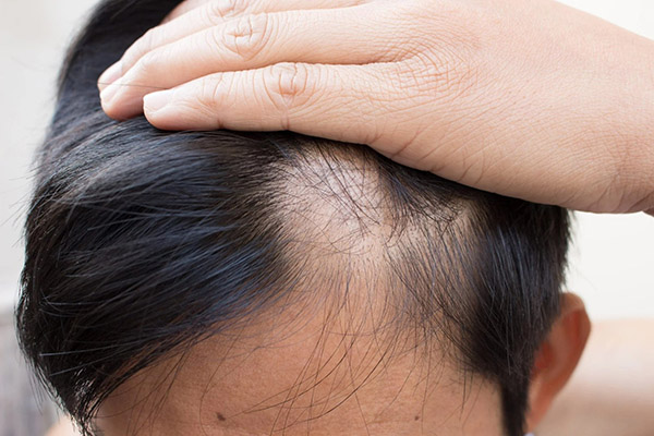 Что такое очаговое выпадение волос: причины, признаки, лечение