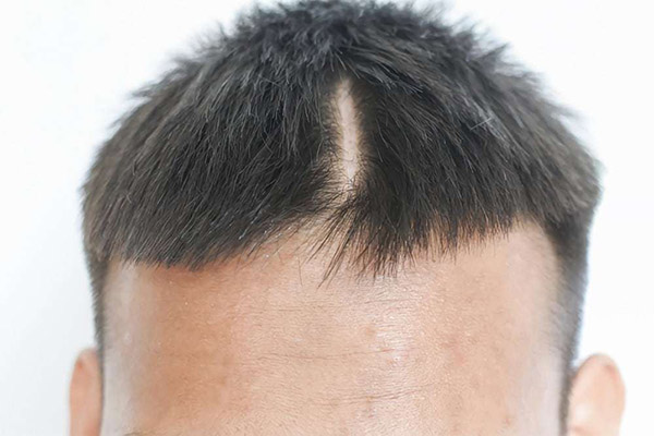 Распространенные типы шрамов на коже головы
