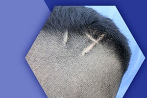 Аюрведа может предотвратить потливость кожи головы и выпадение волос