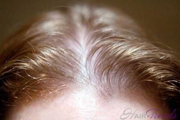 Истончение волос, причины и лечение
