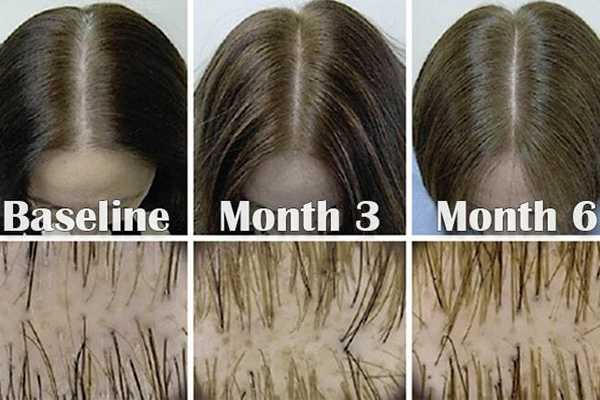 Как миноксидил помогает остановить выпадение волосы у женщин