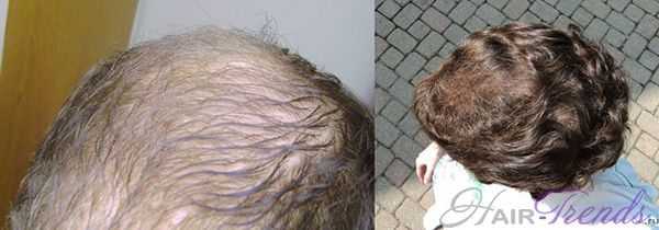 Выпадение волос у мужчин финастерид thumbnail