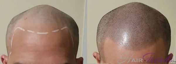 Микропигментация кожи головы при облысении