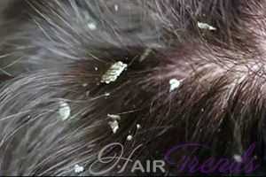 Масло калонджи – применение для лечения выпадения волос