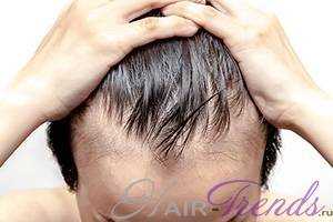 Сильное выпадение волос при мытье головы у мужчин и женщин