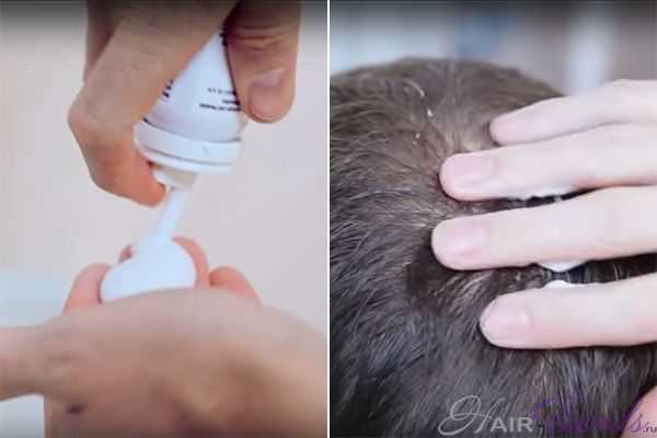 Пена Регейн для волос – применение при облысении