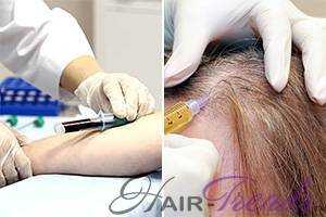 Плазмолифтинг для волос - цена и количество процедур