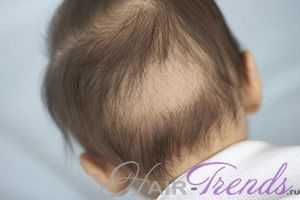 Причины и типы выпадения волос у детей