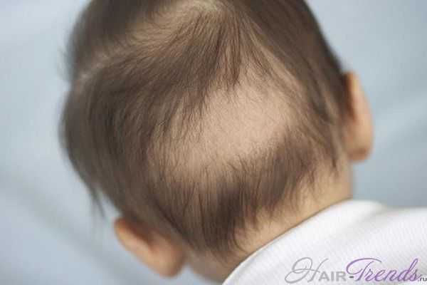 Причины и типы выпадения волос у детей