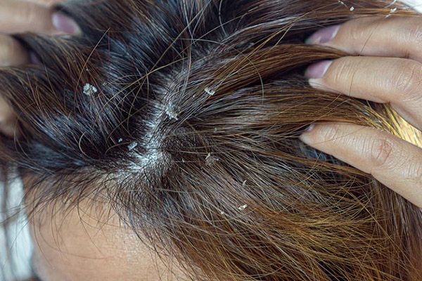 Причины зуда кожи головы при выпадении волос