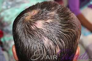 Метформин и выпадение волос