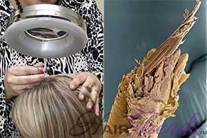 Как предотвратить выпадение волос от стероидов