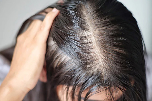 Выпадение волос из-за гормонального дисбаланса и как его лечитьВыпадение волос из-за гормонального дисбаланса и как его лечить