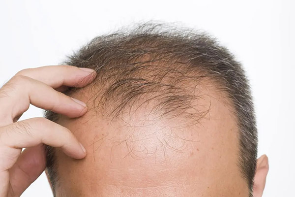 Выпадение волос из-за гормонального дисбаланса и как его лечитьВыпадение волос из-за гормонального дисбаланса и как его лечить
