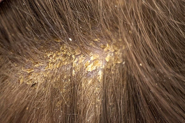 Причины грибка кожи головы