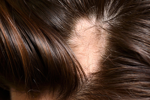 Как грибок кожи головы вызывает выпадение волос