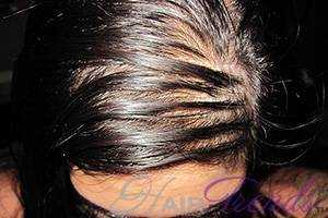 Азелаиновая кислота против выпадения волос